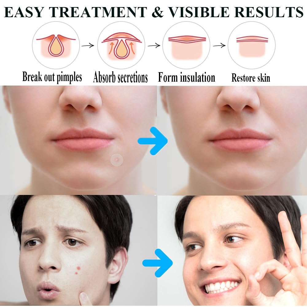 Zemolo 300pcs Pimple Patches Hydrocolloid Acne Stickers with Tea Tree Oil Spot Cover Patches Day & Night Whiteheads Acne Absorbing Blemish Patches Invisible Spot Treatment Stickers