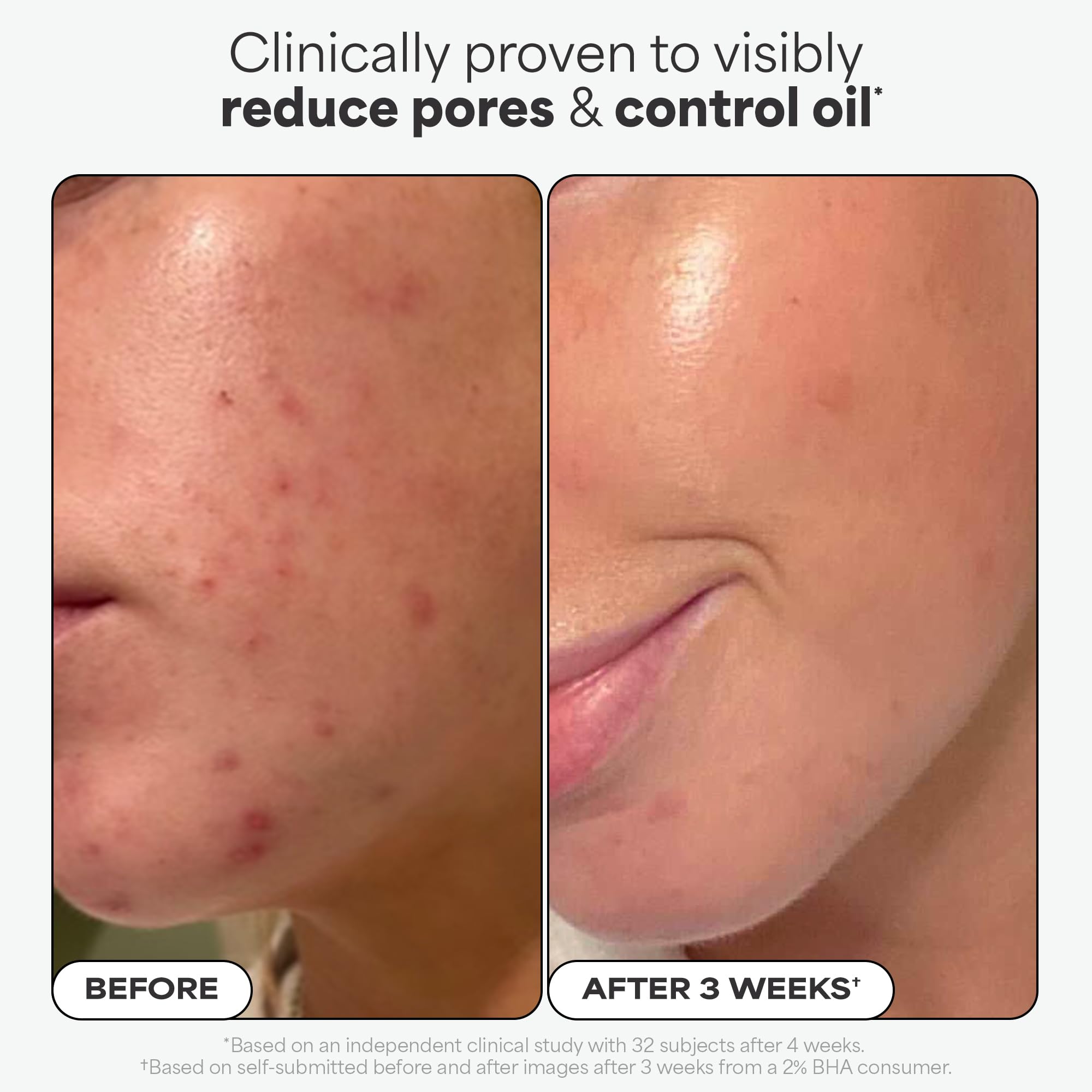 Paulas Choice--SKIN PERFECTING 2% BHA Liquid Salicylic Acid Exfoliant--Facial Exfoliant for Blackheads, Enlarged Pores, Wrinkles & Fine Lines, 4 oz Bottle