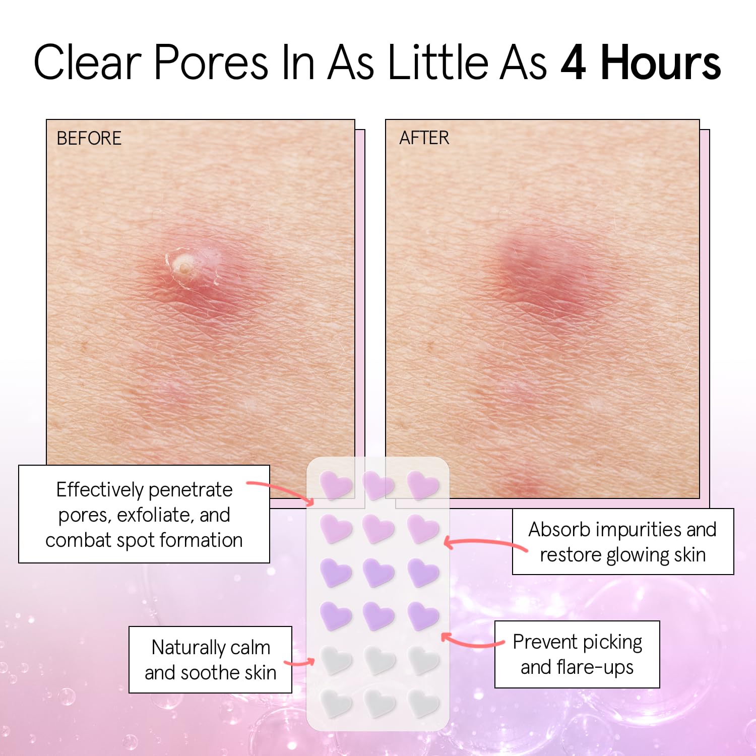 grace & stella Award Winning Pore Strip - Pimple Patches for Face - Heart Hydrocolloid Zit Stickers that Help Soothe & Conceal Breakouts - Cute Patches - Dermatologist-Tested Vegan (Heart, 36 Count)
