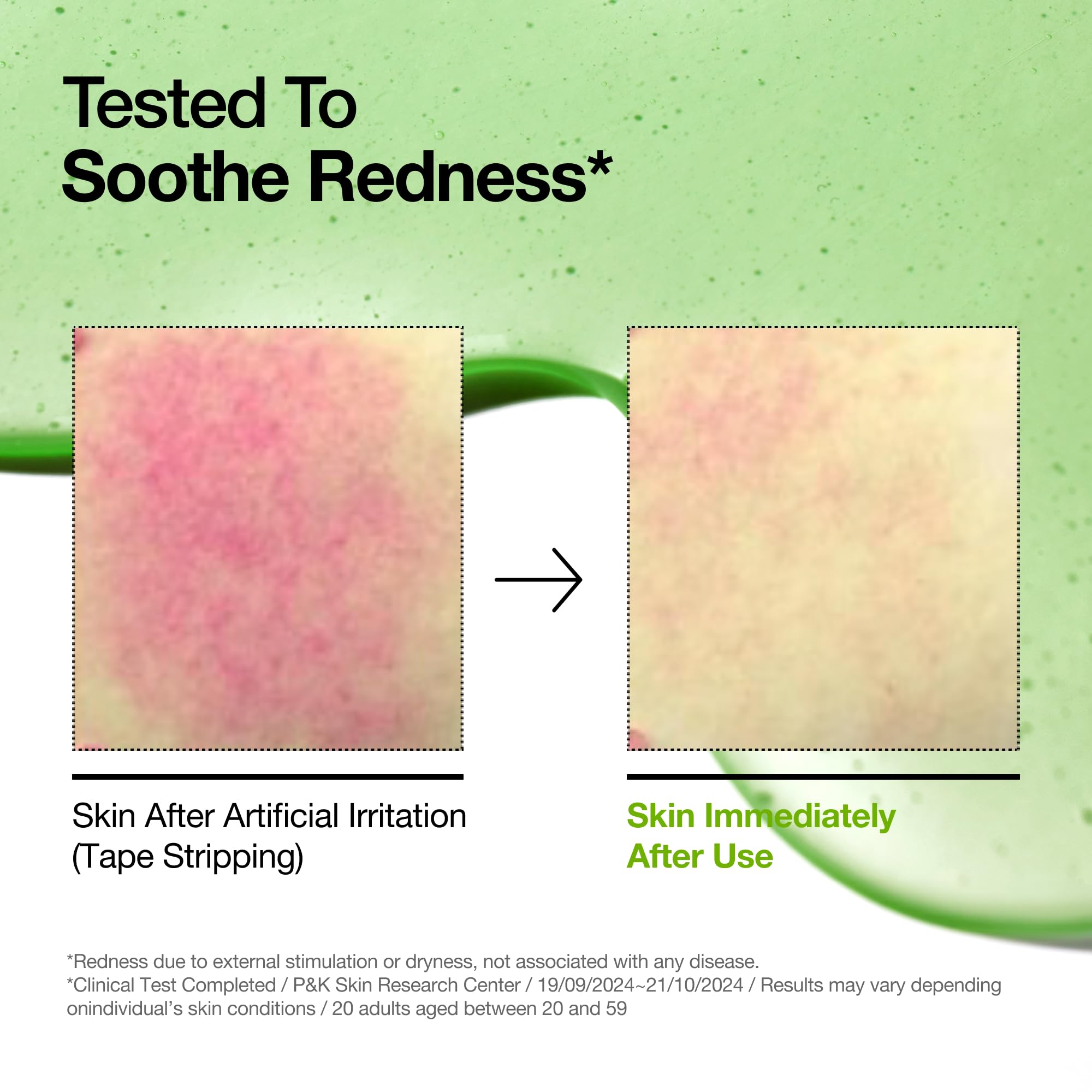 Anua Azelaic Acid 10 Hyaluron Redness Soothing Serum, Facial Serum for Blemish-Prone & Oily-Prone Skin, Lightweight & Hydrating Blemish Care, Hyaluronic Acid, Korean Skincare, 1.01 fl oz.
