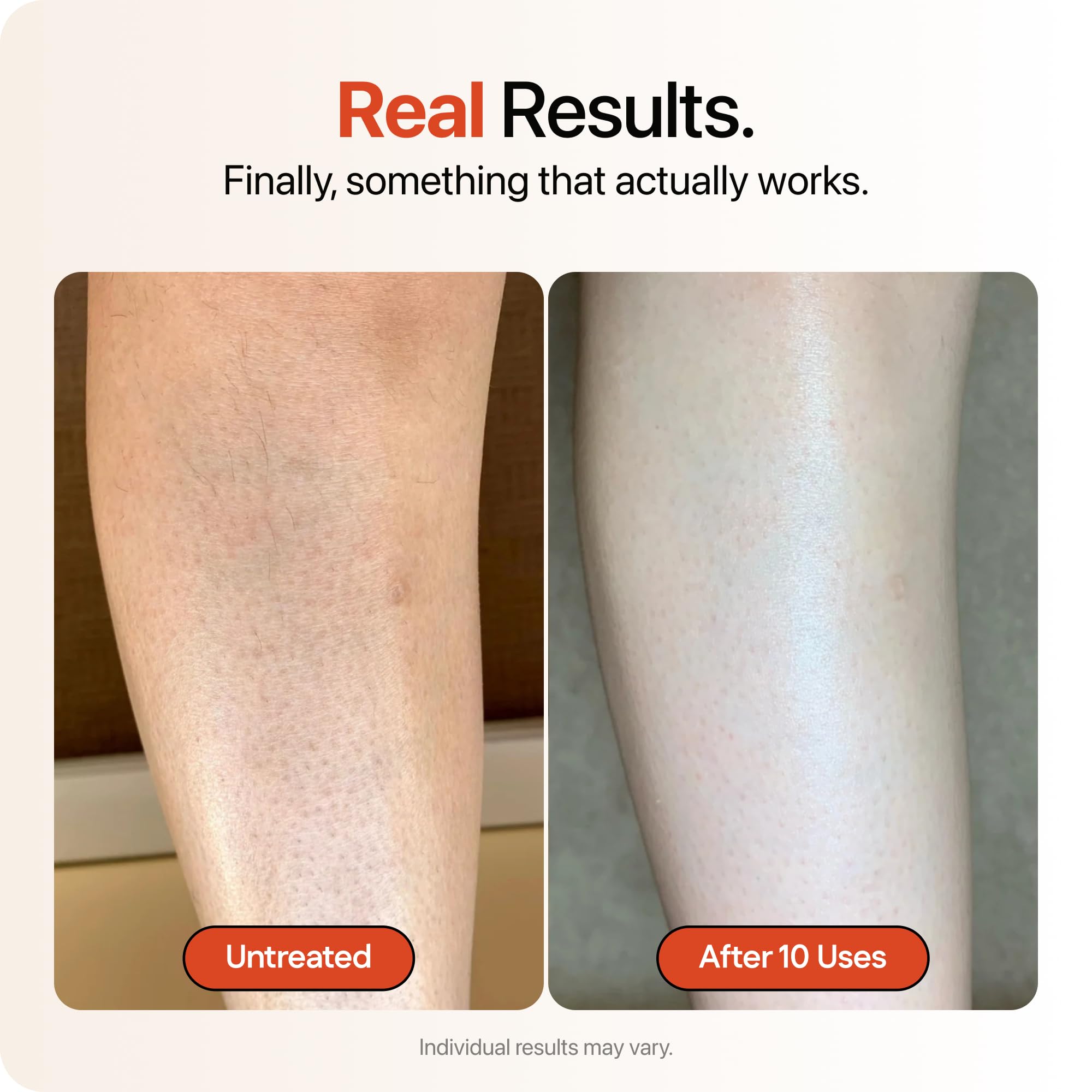 Strawberry® Resurfacing Cream for Keratosis Pilaris - KP Bump Eraser for Strawberry Skin - Exfoliating Lotion with Glycolic, Lactic & Salicylic Acid - Remover for Rough & Bumpy Skin 4 oz