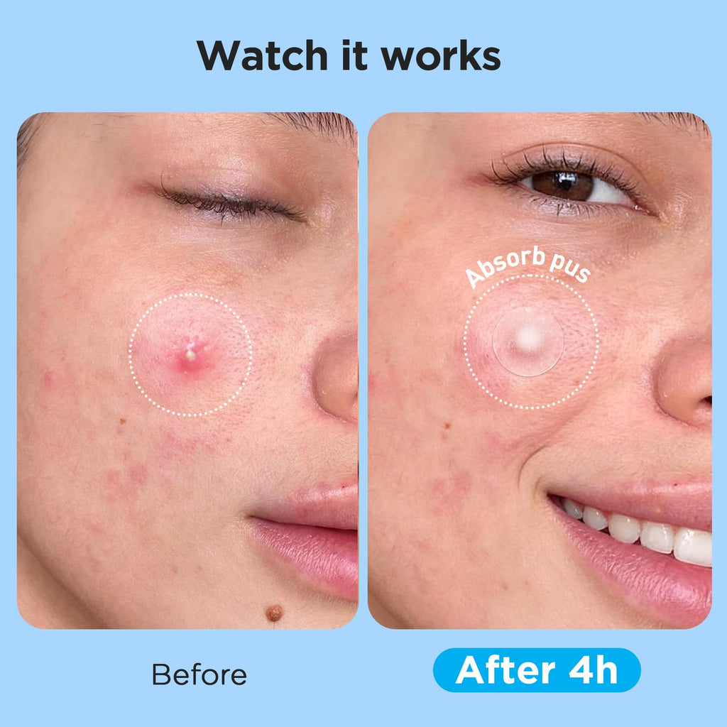 Glowpatch Pimple Patches for Face (504 Count), FSA Eligible Acne Patch Bulk, Zit Stickers 4 Sizes, Hydrocolloid Spot Stickers, Clear Acne Dots for Covering Zits, Blemishes and Breakouts