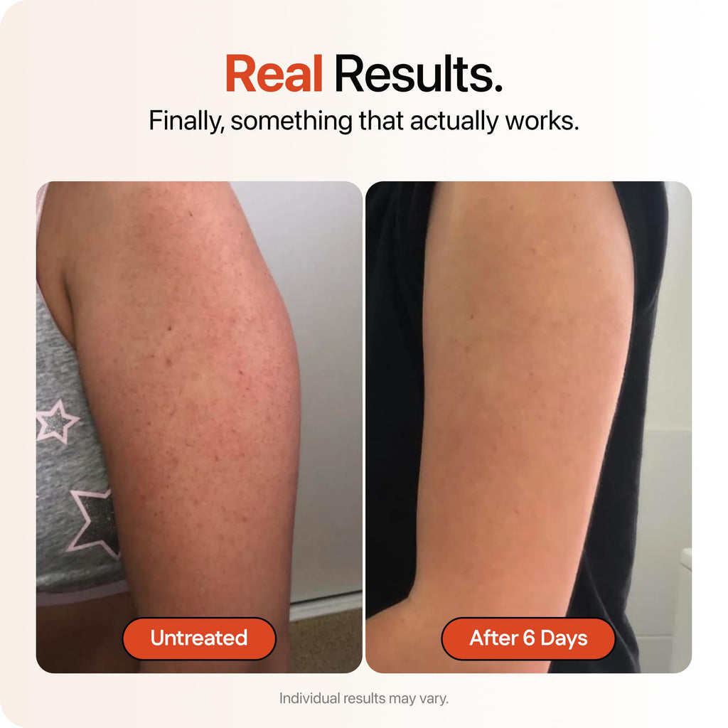 Strawberry® Resurfacing Cream for Keratosis Pilaris - KP Bump Eraser for Strawberry Skin - Exfoliating Lotion with Glycolic, Lactic & Salicylic Acid - Remover for Rough & Bumpy Skin 4 oz