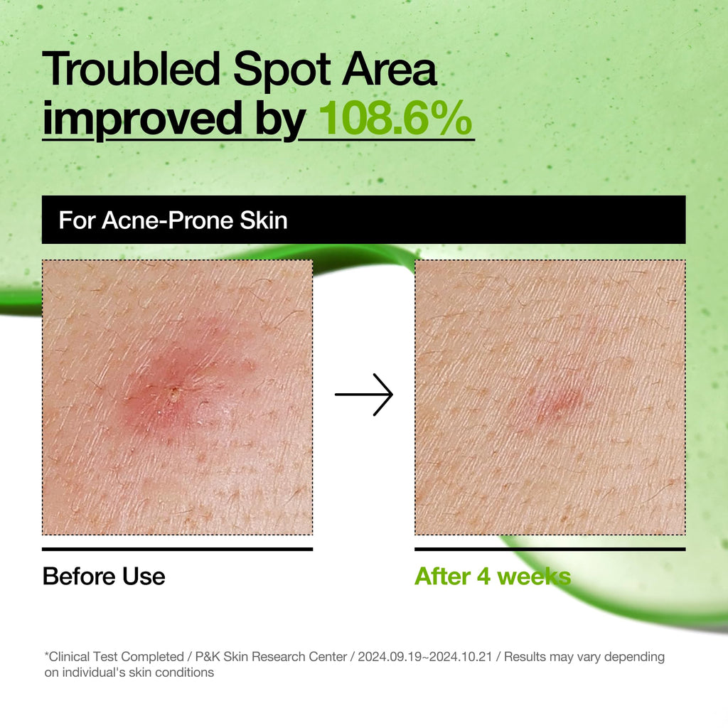 Anua Azelaic Acid 10 Hyaluron Redness Soothing Serum, Facial Serum for Blemish-Prone & Oily-Prone Skin, Lightweight & Hydrating Blemish Care, Hyaluronic Acid, Korean Skincare, 1.01 fl oz.