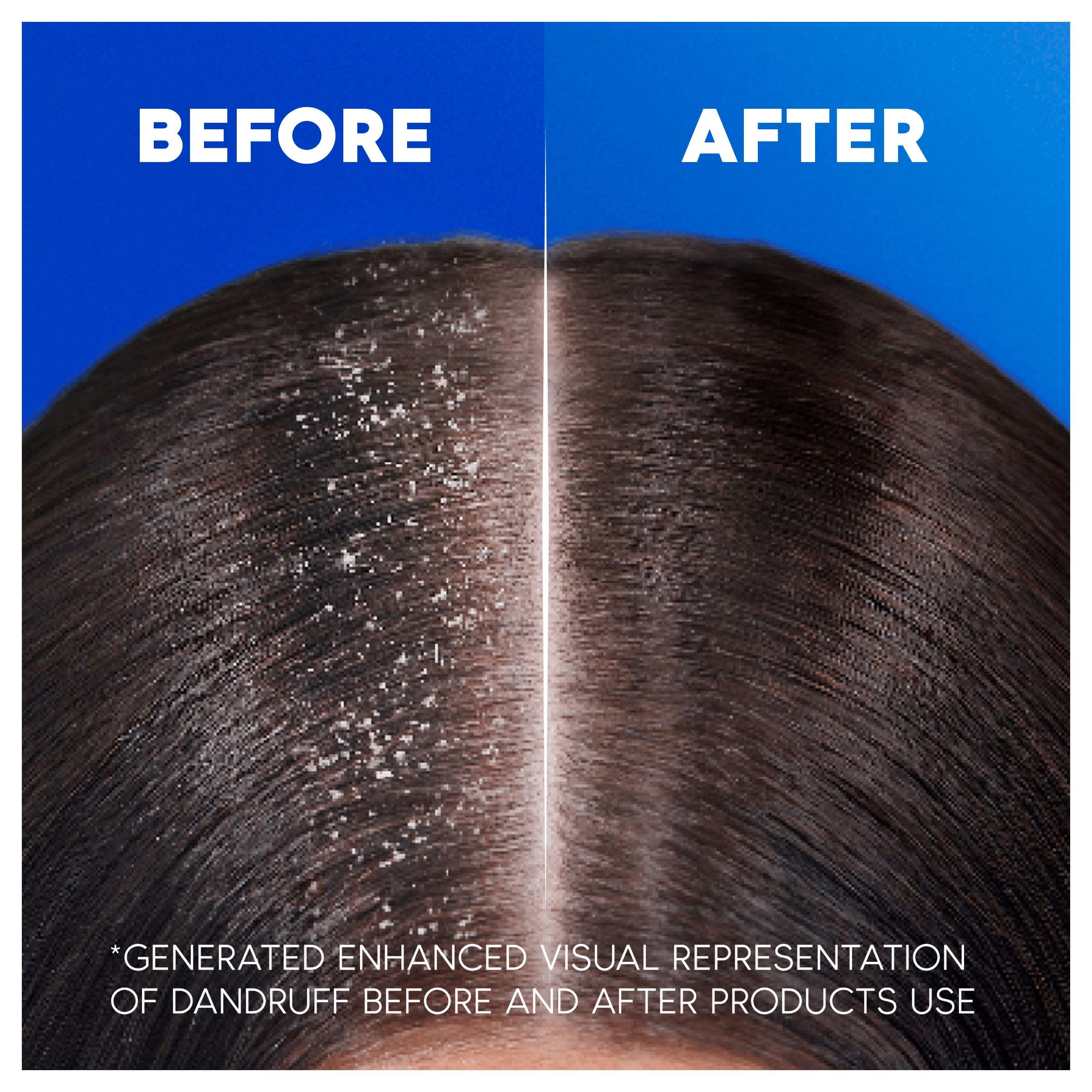 Head & Shoulders Classic Clean 2in1 Anti Dandruff Shampoo, 1000ml. Up to 100% Flake Free, Clinically Proven. For Any Hair and Scalp Type. For Daily use. Clean Feeling